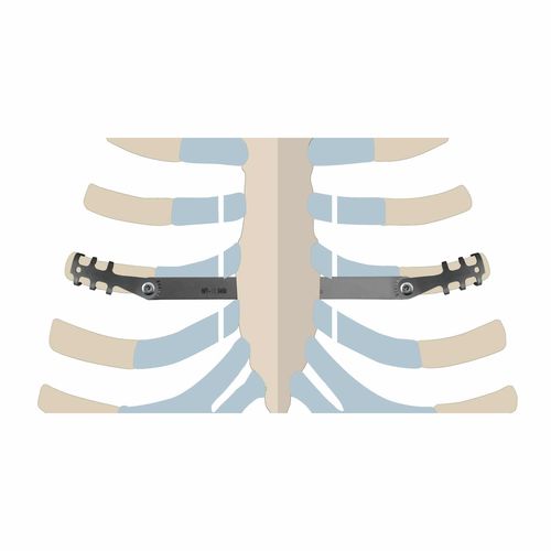 Placa de compressão óssea para costelas - ThoRib® PECTUS - NEURO FRANCE Implants - em titânio / infantil