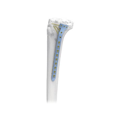 Placa de compressão óssea para tíbia - PNM1054-TP2 - NORMMED Medical Devices - proximal / medial / bloqueada