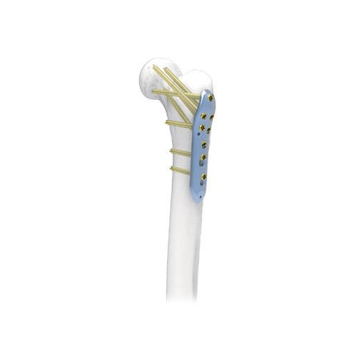 Placa de compressão óssea para fêmur - NORMMED Medical Devices - proximal / bloqueada / metálica