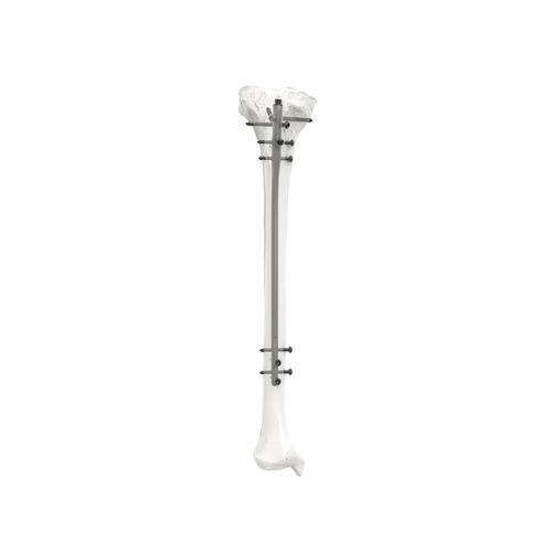 Haste intramedular para tíbia - PNM3308 - NORMMED Medical Devices - fixação diafisária / fixação proximal / metálica