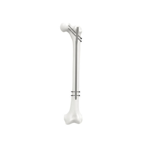 Haste intramedular para fêmur - NORMMED Medical Devices - fixação proximal / fixação diafisária / metálica