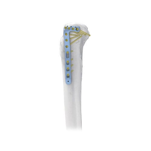 Placa de compressão óssea para tíbia - NORMMED Medical Devices - proximal / lateral / bloqueada