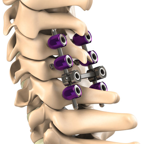 Sistema de osteossíntese cervical - PCS - Aditus Medical - via posterior