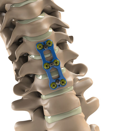 Placa para artrodese cervical - Tİ-6Al-4V ELI  - Aditus Medical - bloqueada / metálica / 2 níveis