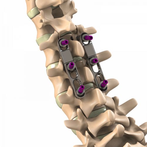 Sistema de osteossíntese toracolombar - Ti-6Al-4V ELI  - Aditus Medical - via posterior