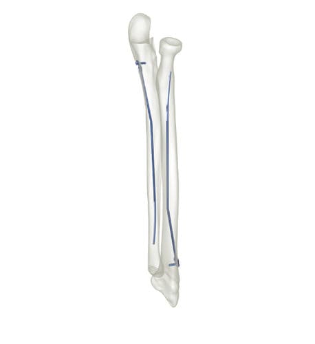 Haste intramedular para rádio - 83527 series - Peditst - para cúbito / em titânio