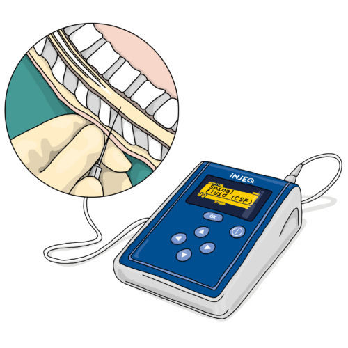 Analisador de química clínica de líquido cefalorraquidiano - Injeq IQ-Tip® - Injeq Ltd. - automático / de bancada