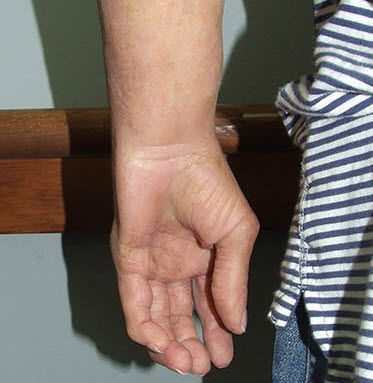 Prótese estética de mão - Medical Art Prosthetics - para adulto