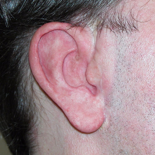 Prótese estética auricular - Prosthetic Illusions - para adulto