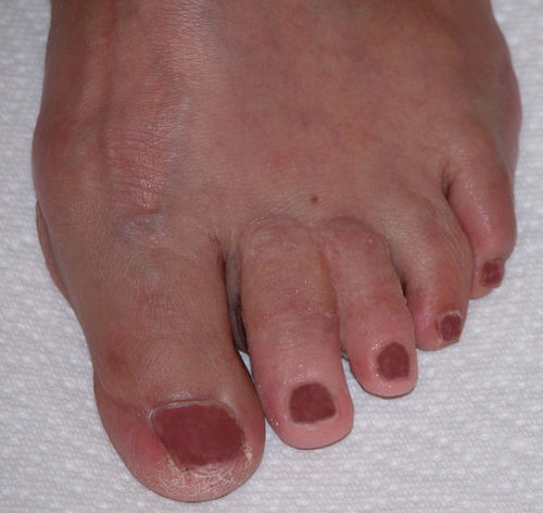 Prótese estética dedo do pé - Prosthetic Illusions - para adulto