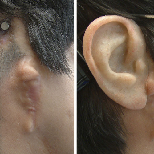 Prótese estética auricular - Prosthetic Artists - para adulto