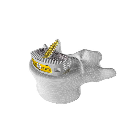 Espaçador intervertebral lombar - M3 STAND-ALONE ALIF - Corelink Surgical - via anterior