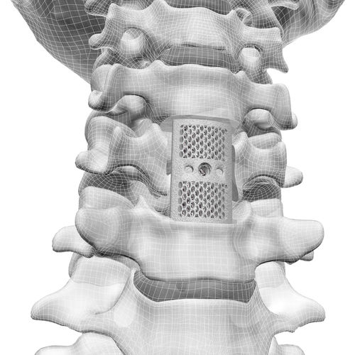 Prótese vertebral cervical - F3D - Corelink Surgical - impressa em 3D