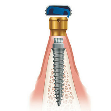 Implante dentário em titânio - Zest Dental Solutions - anatômico / estreito / de ancoragem ortodôntica