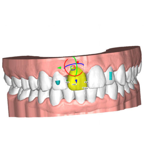 Software de planejamento de tratamento - ALIGNER - Coruo - de concepção de prótese dentária / de design digital de sorriso / de simulação 3D