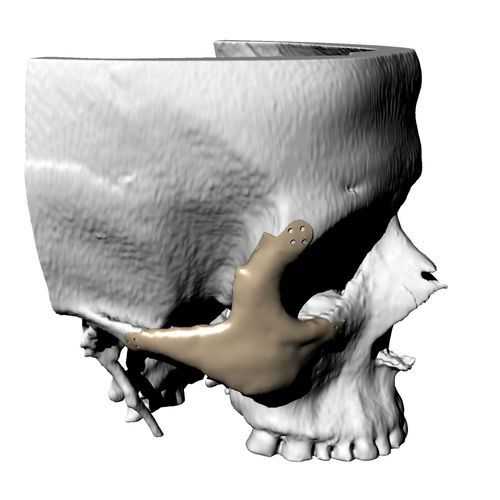 Implante orbitário sob medida - Kune Implants - não absorvível