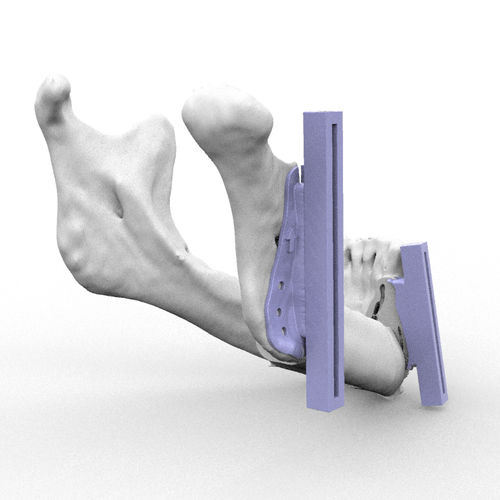 Guia de ressecção para reconstrução maxilofacial - RMP - Kune Implants