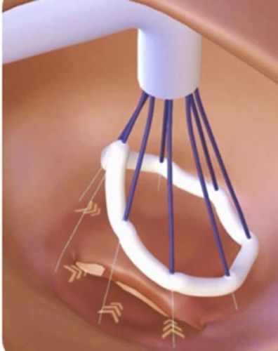Sistema de reparação cardíaca de válvula mitral - Valfix Medical - para válvula tricúspide
