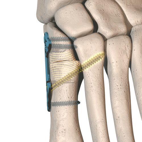 Placa de osteotomia para hálux valgo - dynaBunion® - CrossRoads Extremity Systems