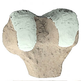 Modelo de joelho - Ortho Baltic - cirúrgico