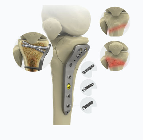 Placa de compressão óssea proximal - 1572 series - Zimed Medical - para tíbia / medial / bloqueada