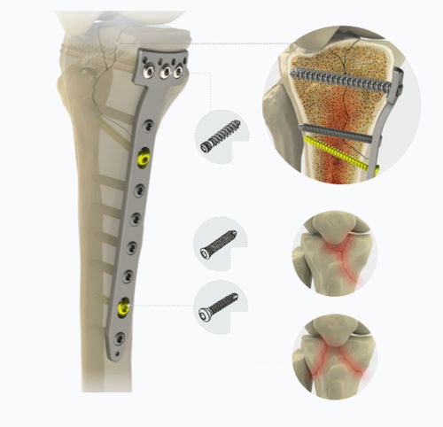 Placa de compressão óssea proximal - 1792 series - Zimed Medical - para tíbia / medial / bloqueada
