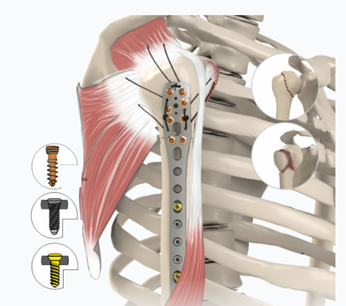 Placa de compressão óssea para úmero - 1912 series - Zimed Medical - proximal / lateral / bloqueada