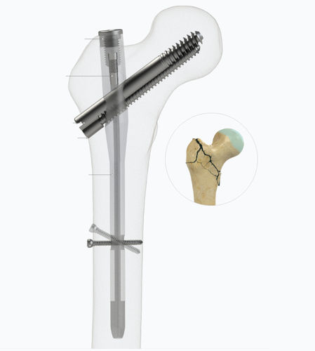 Haste intramedular para fêmur - 4552-1017 - Zimed Medical - fixação proximal / para lado direito / para lado esquerdo