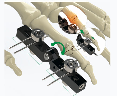 Fixador externo para articulação metacarpofalangeana - 5084-0000 - Zimed Medical - tubular