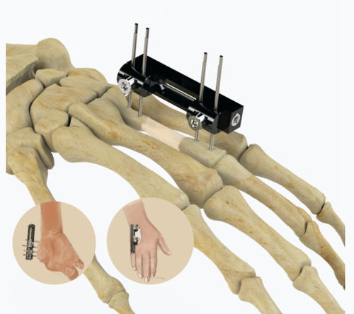 Fixador externo para articulação metacarpofalangeana - 5084 series - Zimed Medical - tubular