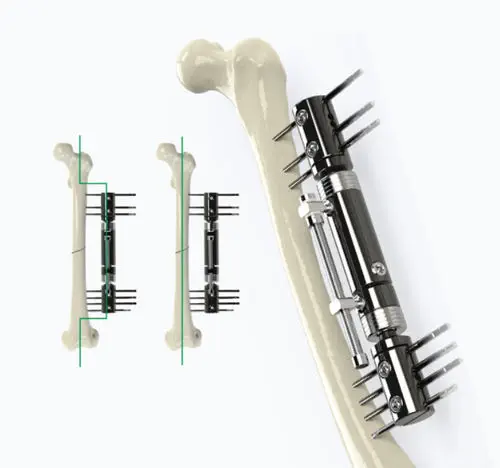 Fixador externo para tíbia - 5014 series - Zimed Medical - para