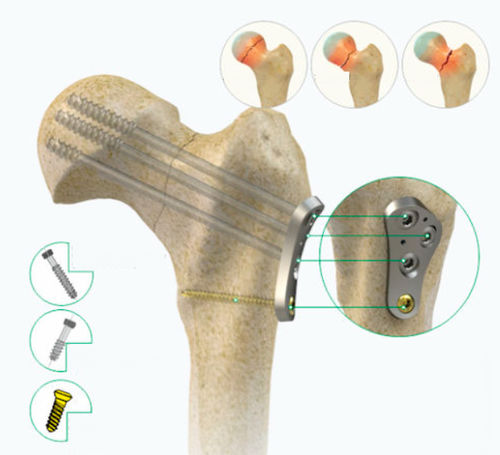 Placa de compressão óssea para cabeça femoral - Zimed Medical - proximal / lateral / bloqueada