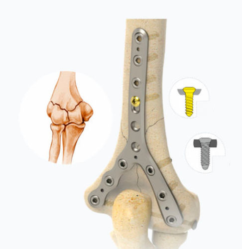 Placa de compressão óssea para úmero - 1512 series - Zimed Medical - distal / bloqueada / metálica
