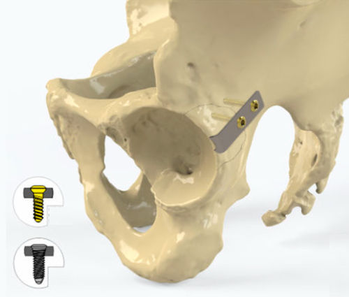 Placa de compressão óssea para acetábulo - Zimed Medical - bloqueada / metálica