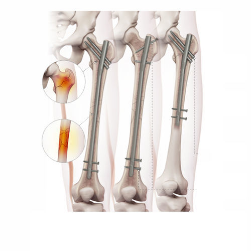 Haste intramedular para fêmur - 4602-0918 - Zimed Medical - fixação proximal / fixação distal / para lado direito