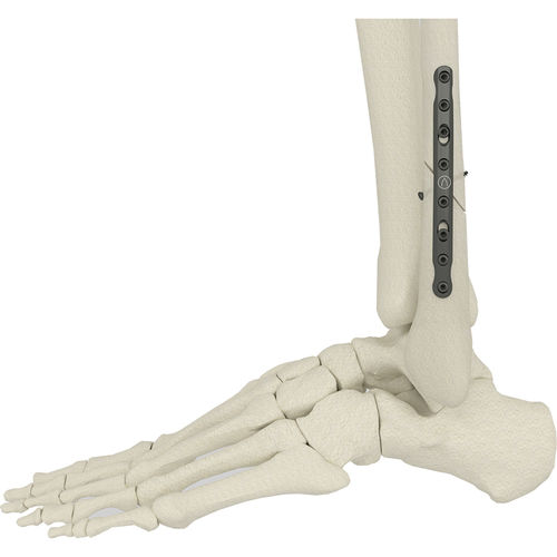 Placa de osteotomia para fíbula - PK-SFP series - WishBone Medical - medial / não bloqueada / metálica
