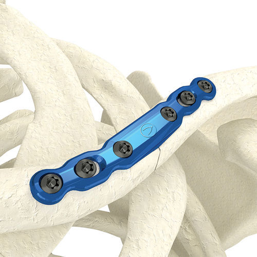 Placa de compressão óssea para clavícula - PK-SMC0635NL-TI - WishBone Medical - medial / metálica / infantil