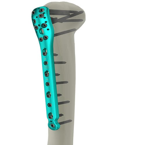 Placa de compressão óssea para úmero - 10-2200 series - WishBone Medical - proximal / bloqueada
