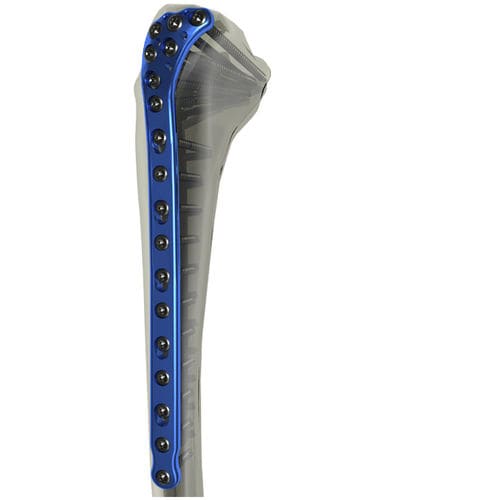 Placa de compressão óssea para tíbia - WishBone Medical - proximal / bloqueada / em titânio