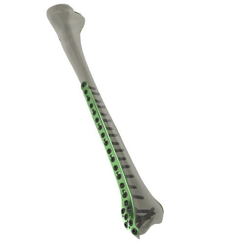 Placa de compressão óssea para tíbia - WishBone Medical - distal / bloqueada / em titânio