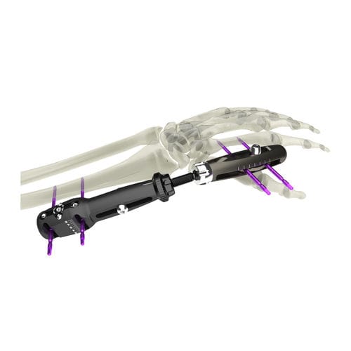 Fixador externo para punho - UniX® - WishBone Medical - para rádio / tubular