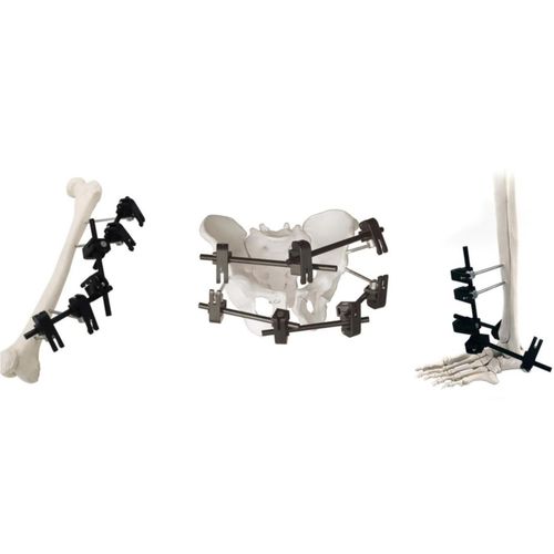 Fixador externo modular - QuickX  - Zhejiang Borumon Biological Technology - tubular