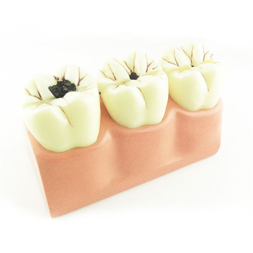 Modelo de dente - UM-L10 4 - Tangshan UMG Medical Instrument - para ensino / para cáries / de resina