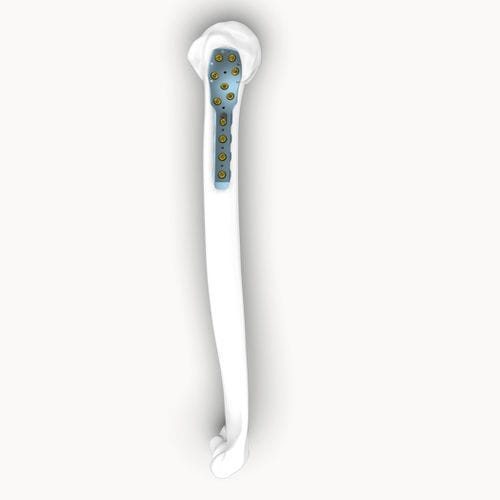 Placa de compressão óssea para úmero - Eonex Medical - proximal / bloqueada / não bloqueada
