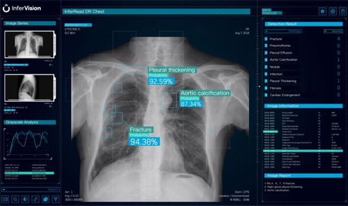 Software de análise - DR Chest - Beijing Infervision Technology Co. Ltd. - de visualização / de criação de laudos / médico-hospitalar