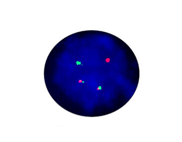 Kit de teste de gene de fusão EML4-ALK - CF1012 - Celnovte Biotechnology Co., Ltd. - de febre tifoide / para pesquisa / do câncer do pulmão