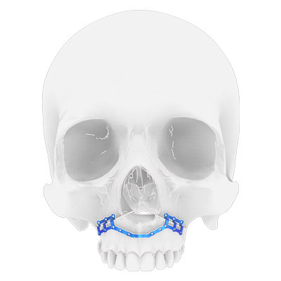 Placa de osteotomia para maxilar - Osteophoenix - em titânio