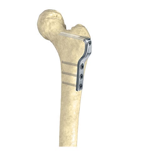 Placa de osteotomia para fêmur - Wuxi Betta Medical Technology - proximal / bloqueada / metálica