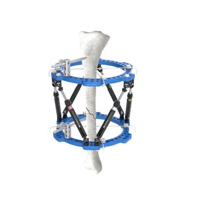 Fixador externo para tíbia - Wuxi Betta Medical Technology - para tornozelo / circular