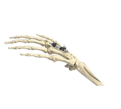 Fixador externo para articulação metacarpofalangeana - Wuxi Betta Medical Technology - tubular